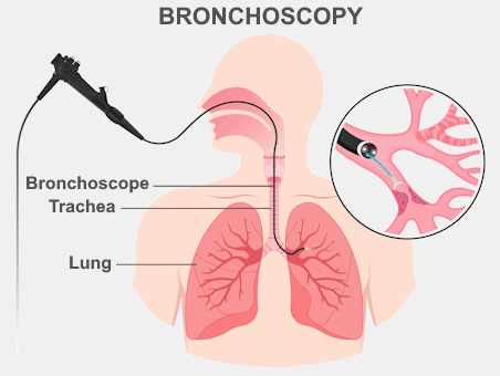 Anatomical illustration of a bronchoscope passing down an airway into the lung.