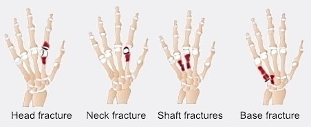 Illustration showing types of break (fracture) with a broken hand bone. Fractures are at the head, neck, shaft and base of the metacarpals.