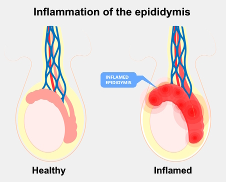 Testicle and inflamed epididymis Anatomic illustration showing the testicle and inflammation of the epididymis